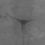 幼稚子宫的治疗