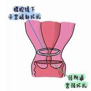 宫颈松弛