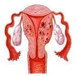 腺肌症与反复流产