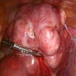 子宫肌瘤怎么治？