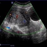 腺肌症吃点止痛药行吗，哪种药好？