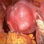 子宫肌瘤和剖腹产一块做行吗？