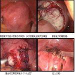 子宫肌瘤不做手术害怕切掉子宫