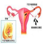 子宫内膜异位症概述