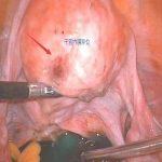 子宫内膜异位与不孕