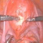 子宫内膜异症与腺肌症