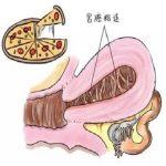 宫腔粘连症状之月经异常