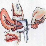 为什么会发生宫腔粘连？