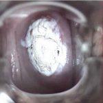 宫颈糜烂哪些人需要治疗？