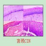 宫颈上皮内瘤变CIN