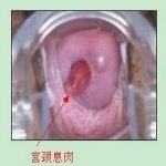 关于宫颈息肉