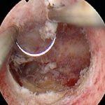 宫腔粘连的治疗误区