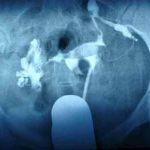 做了输卵管通水是好的为啥还是不怀孕 ？