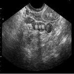 输卵管堵塞在B超下检查出来吗？