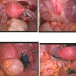 试管婴儿与输卵管阻塞