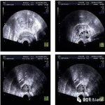 多囊卵巢综合症彩超检查