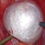 卵巢囊肿之卵巢巧克力囊肿