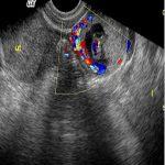 宫外孕检查有哪些?