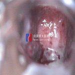 如何治疗阴道闭锁