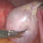 关于卵巢畸胎瘤