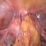 不孕不育症状之腹痛