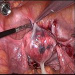 不孕不育的症状之痛经