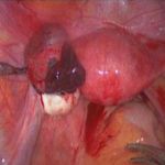 宫外孕三D腹腔镜治疗六大优势