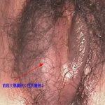 处女的外阴长了包 莫慌-这是前庭大腺囊肿