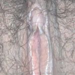 阴蒂包皮过长-阴蒂暴露术