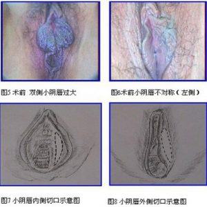 小阴唇过大/小阴唇不对称