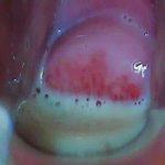 反复感染阴道炎治疗绝招——换菌术