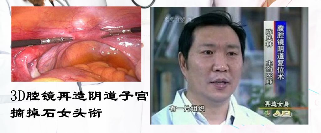 先天性无子宫无阴道-石女再造女身