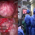 子宫腺肌症保宫治疗