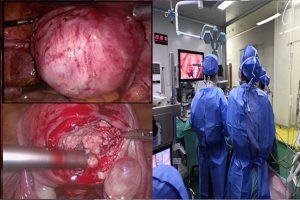 子宫腺肌症保宫治疗