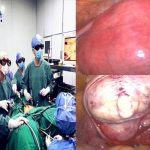 子宫肌瘤-捍卫子宫新技术