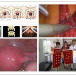 子宫脱垂悬吊(tot)子宫修复术