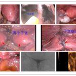 子宫畸形-子宫矫正术