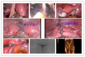 子宫畸形
