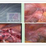 子宫内膜异位症三D腔镜剪灭