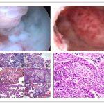 不孕6年是多发性子宫内膜息肉在作怪