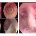 子宫腔粘连诊疗