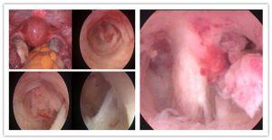 子宫腔粘连诊疗