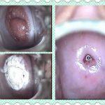 宫颈糜烂-安太液