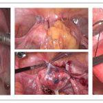 盆腔粘连专科治疗