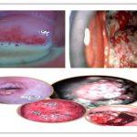 阴道炎绿色疗法-换菌