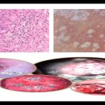 外阴白斑-外阴白色病变