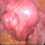 怀孕后子宫肌瘤怎么办？