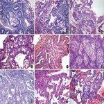 关于子宫内膜息肉