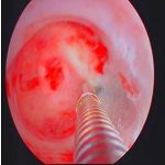 习惯性流产与宫腔粘连