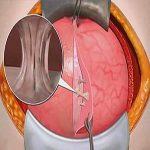 宫腔粘连有何症状？